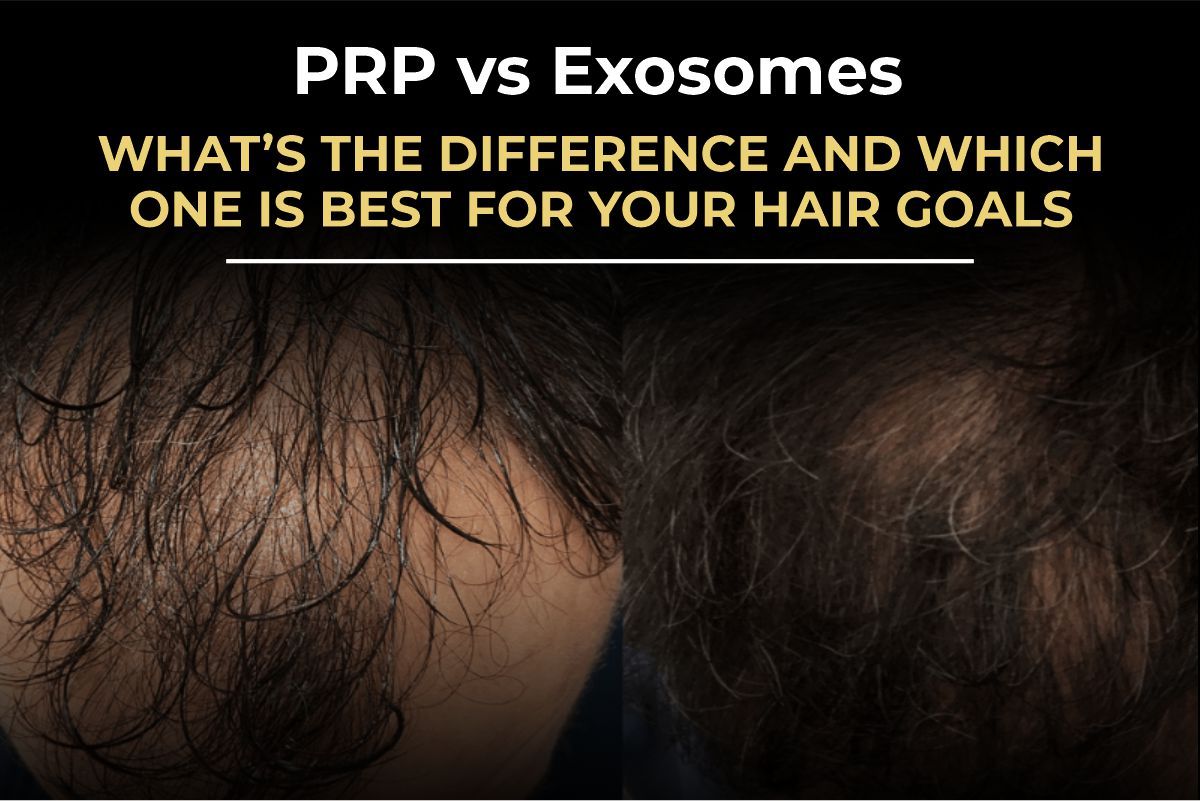 PRP vs. Exosomes for Hair Loss: Which Regenerative Therapy is Best? (2026)