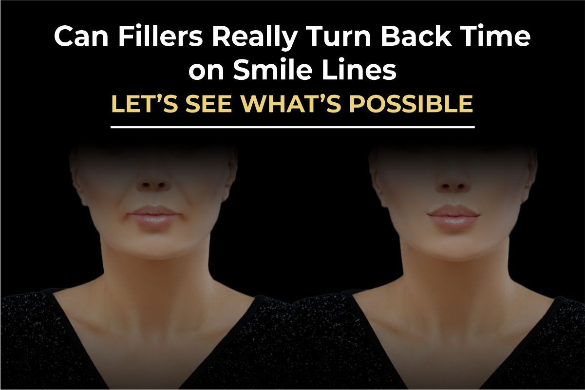 Can Fillers Turn Back Time on Smile Lines? The Surgeon’s Guide to Nasolabial Folds (2026)