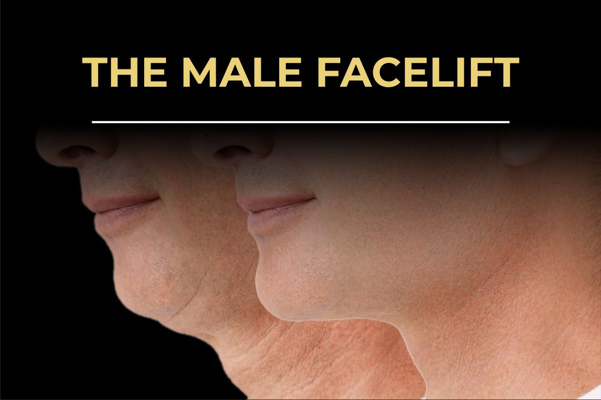Male facelift jawline results before and after by Consultant Surgeon Dr. Salman Aesthetics Pakistan.