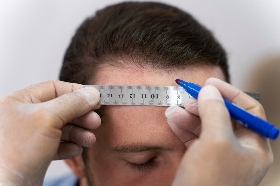 FUE hair transplant hairline results before and after by Consultant Surgeon Dr. Salman Aesthetics Pakistan.