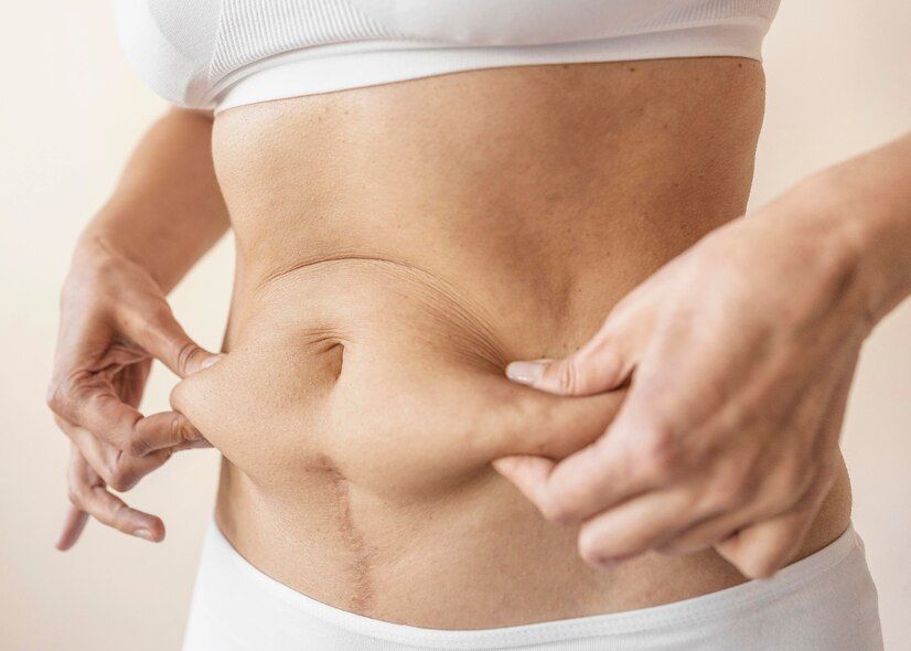 What is a Reverse Tummy Tuck? The Surgeon’s Guide to Upper Abdominal Contouring (2026)